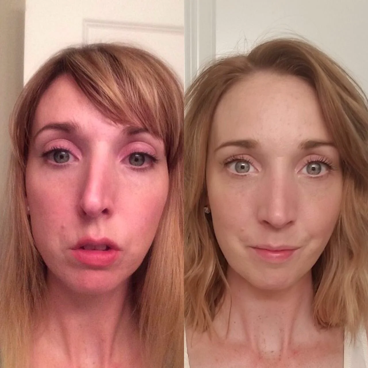 Antes y después de rinoplastia ultrasónica, vista frontal, resultado a 6 meses