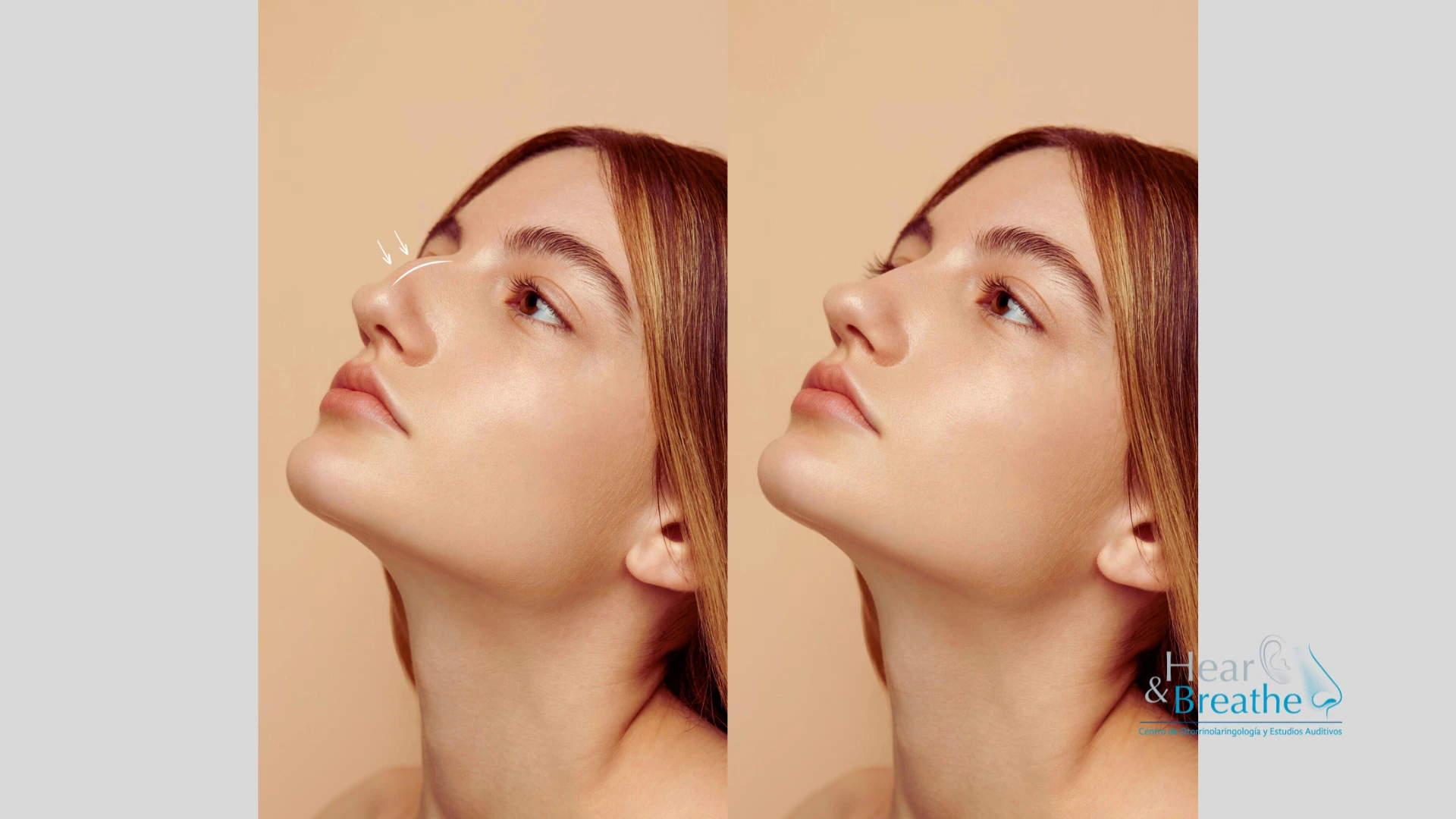 Rinoplastia 3 rinoplastia en cancun