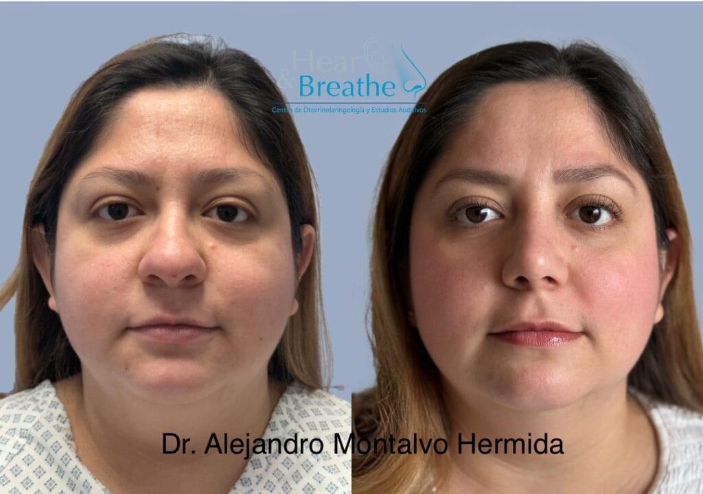 Rinoplastia 12 rinoplastia en cancun