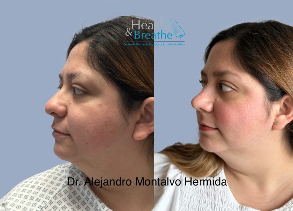 Rinoplastia 13 rinoplastia en cancun