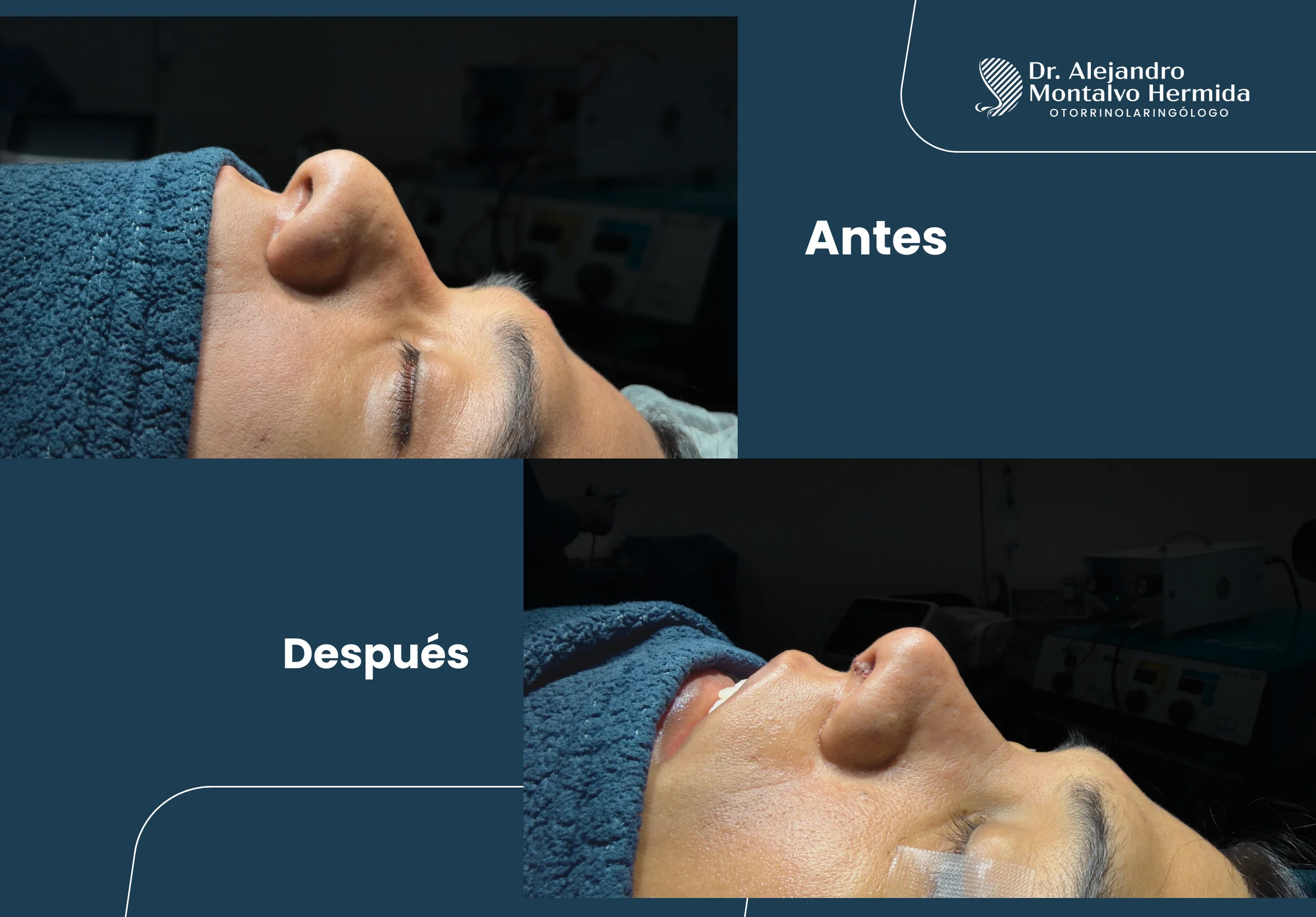 Rinoplastia 3 Dr-montalvo-cirugia-nasal