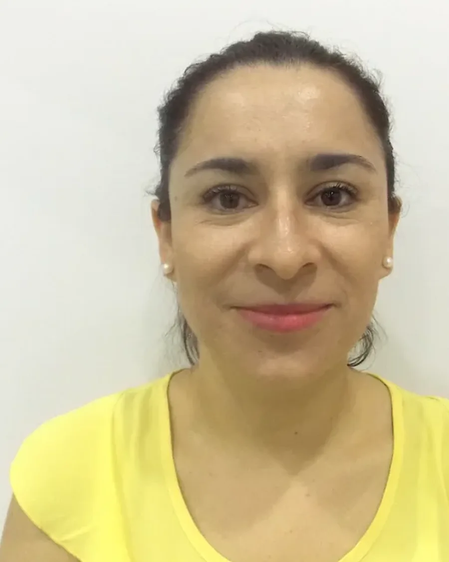 Antes de rinoplastia ultrasónica, vista frontal
