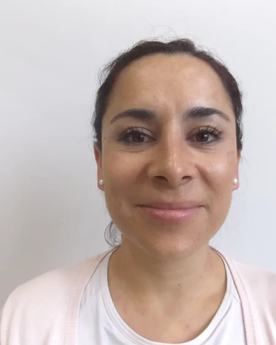 Después de rinoplastia ultrasónica, vista frontal