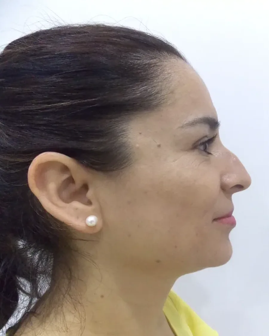 Antes de rinoplastia ultrasónica, vista de perfil