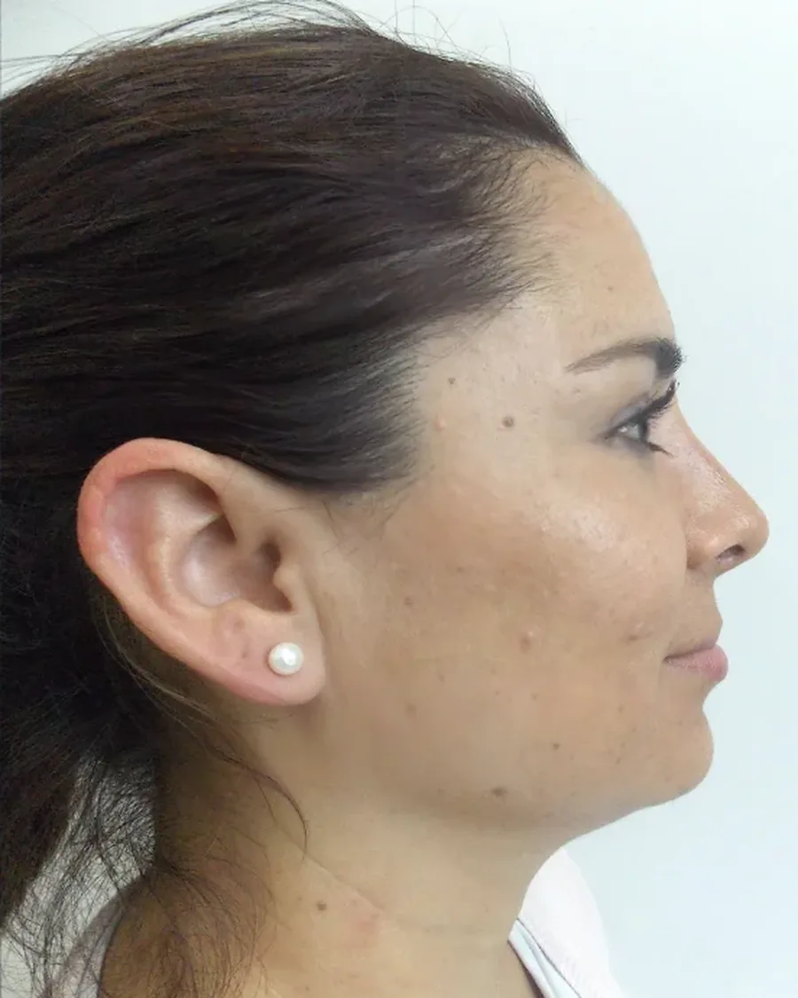 Después de rinoplastia ultrasónica, vista de perfil