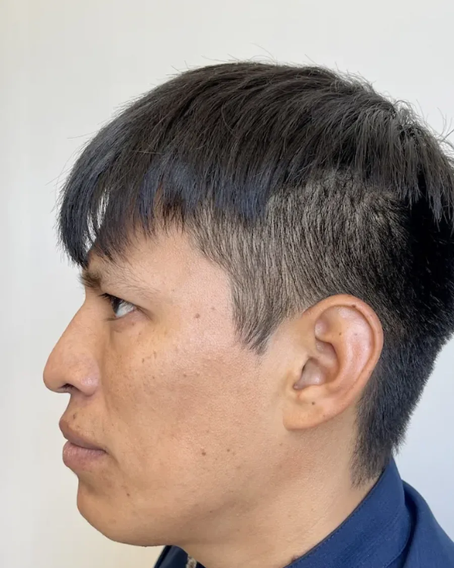 Antes de rinoplastia ultrasónica en hombre, vista de perfil