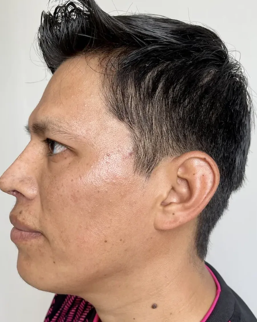Después de rinoplastia ultrasónica en hombre, vista de perfil