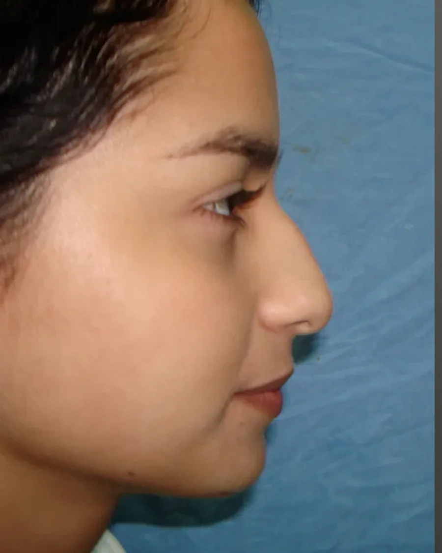 Antes de rinoplastia ultrasónica, vista de perfil