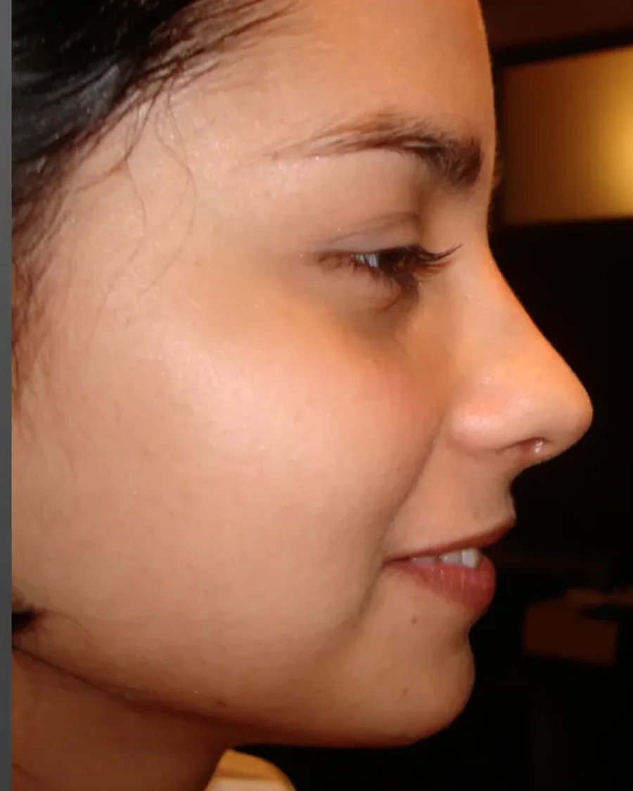 Después de rinoplastia ultrasónica, vista de perfil