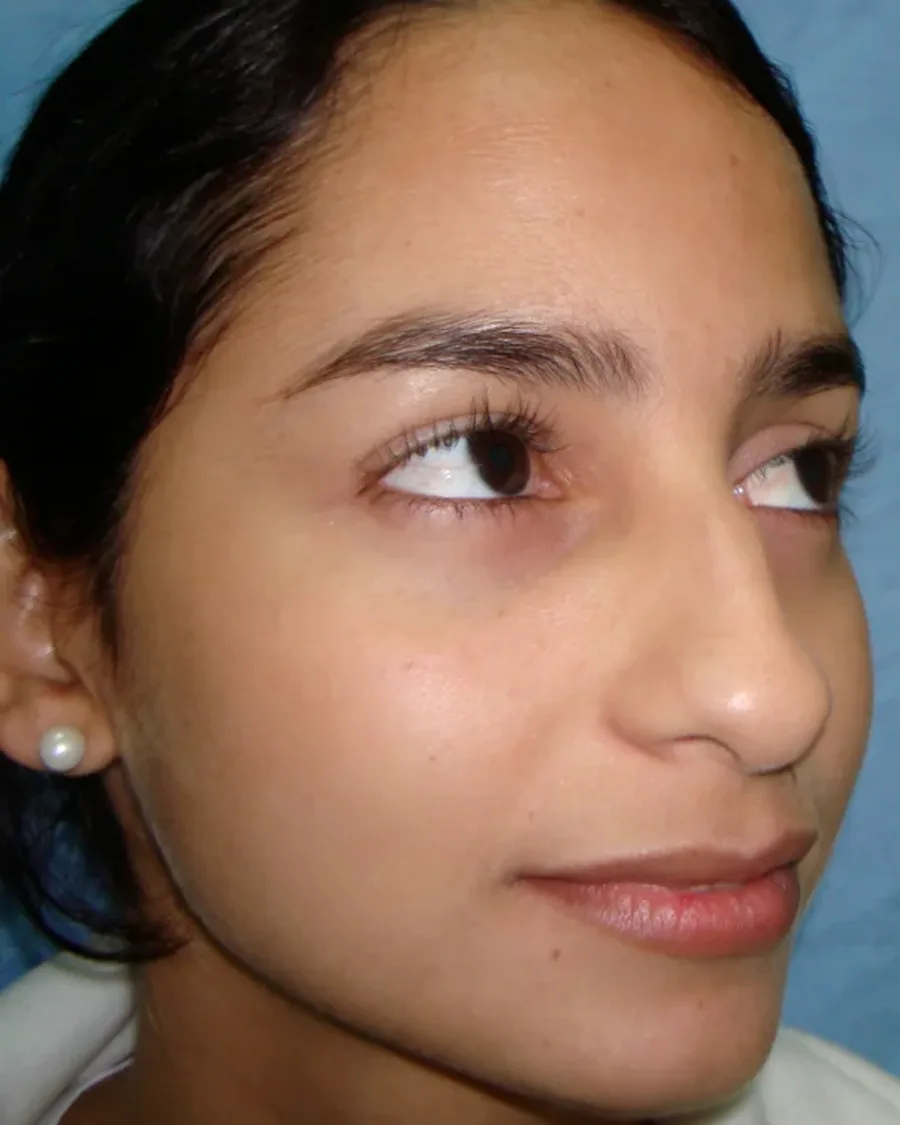 Antes de rinoplastia ultrasónica, vista tres cuartos