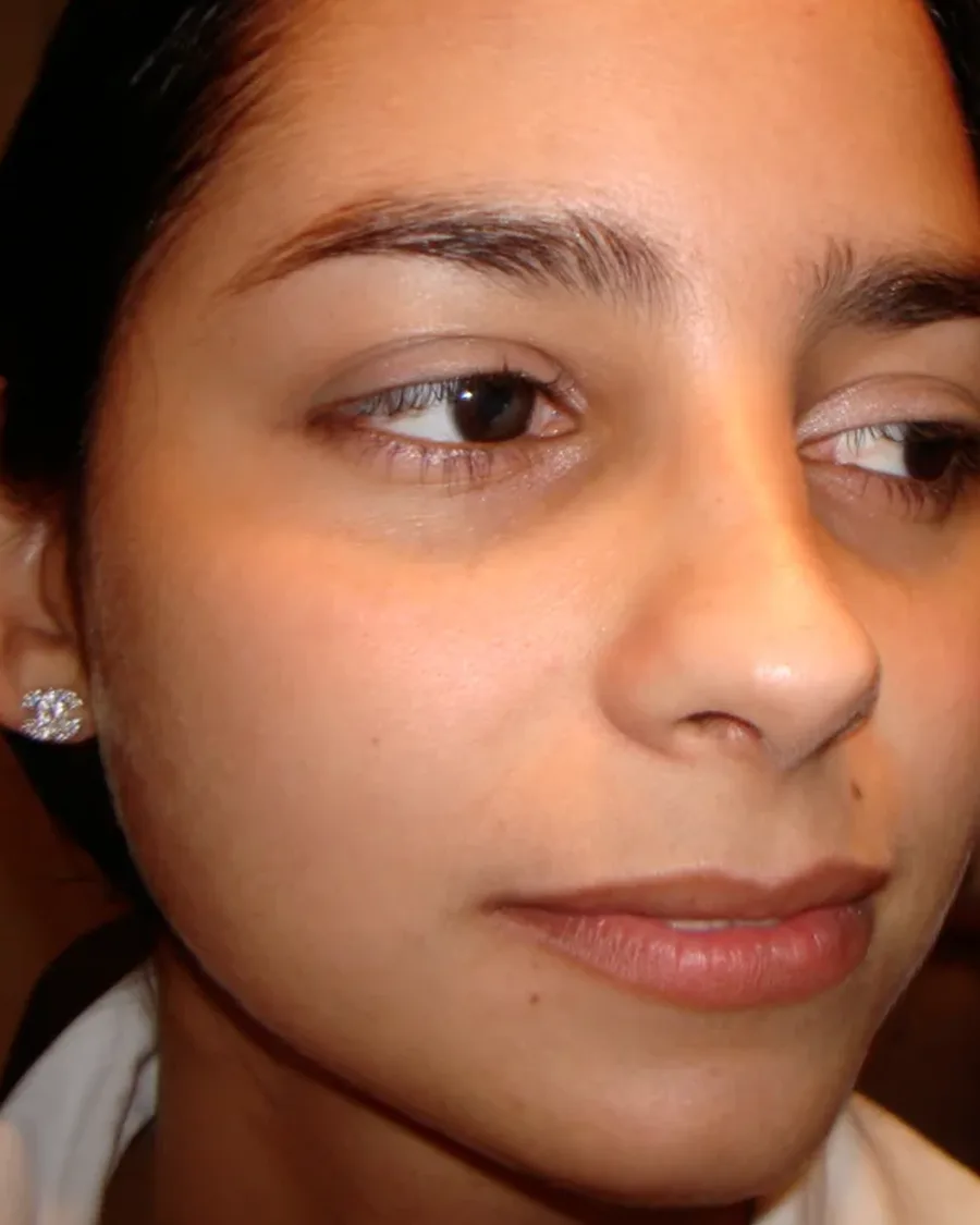 Después de rinoplastia ultrasónica, vista tres cuartos