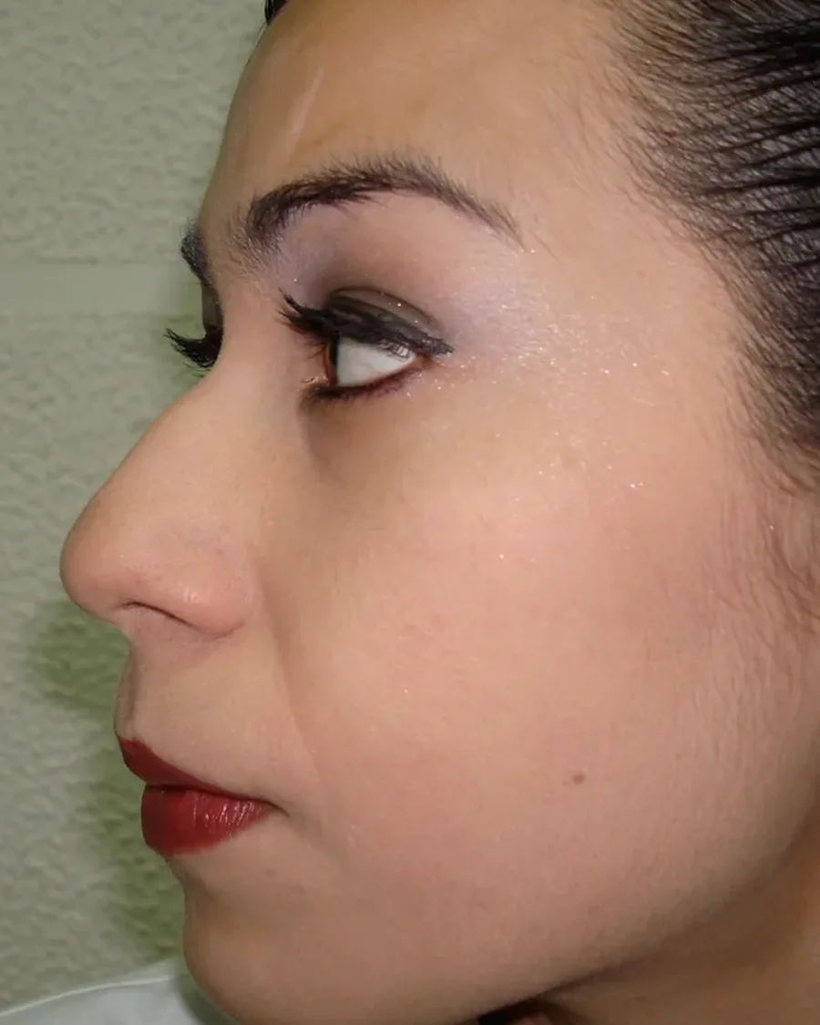 Antes de rinoplastia ultrasónica, vista de perfil