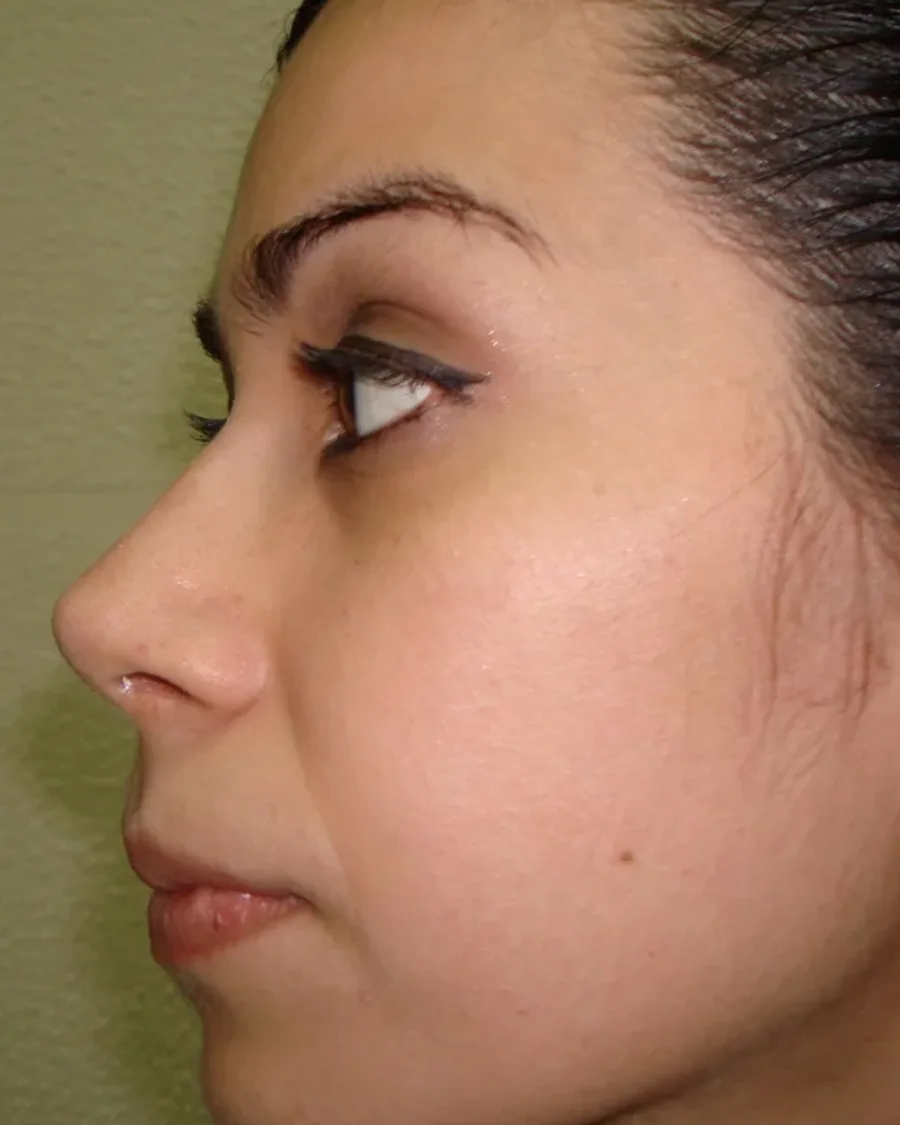 Después de rinoplastia ultrasónica, vista de perfil