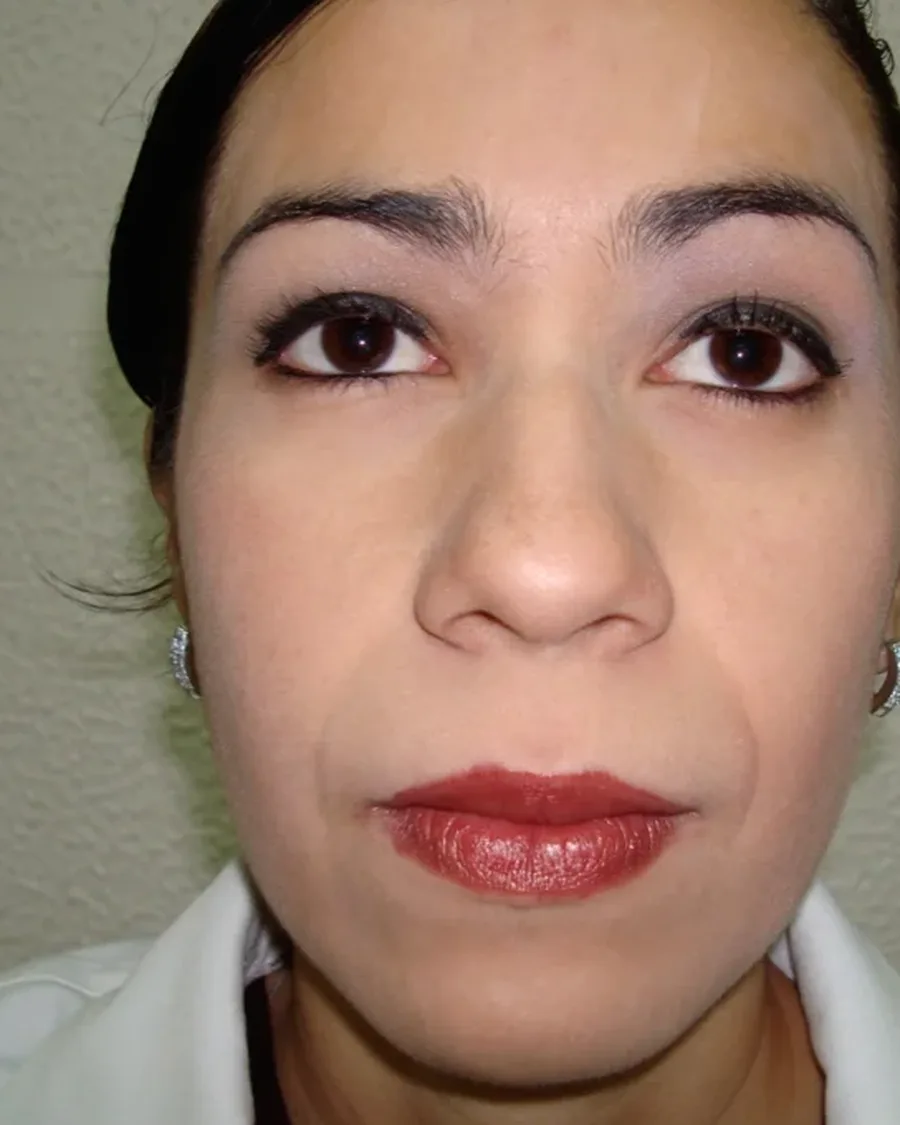 Antes de rinoplastia ultrasónica, vista frontal