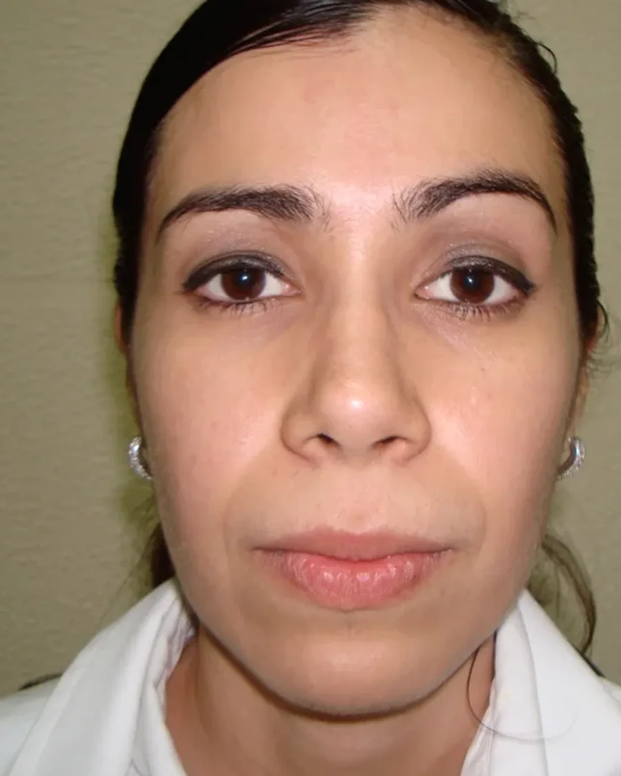 Después de rinoplastia ultrasónica, vista frontal