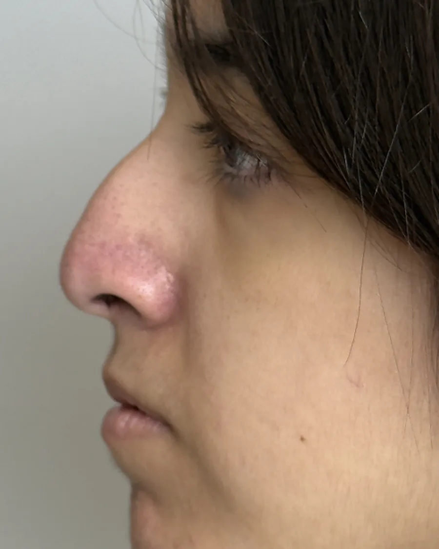 Antes de rinoplastia ultrasónica, vista de perfil