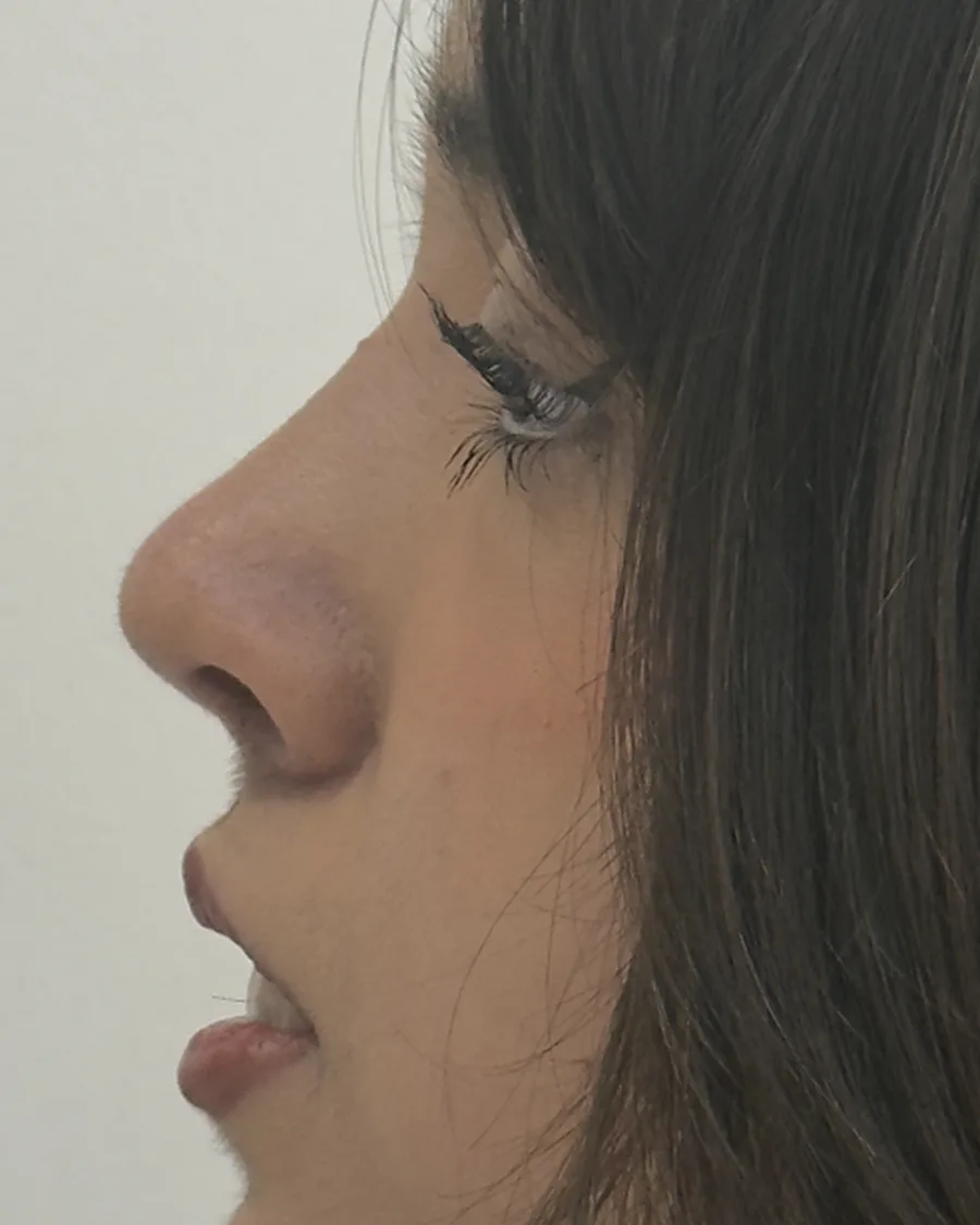 Después de rinoplastia ultrasónica a un mes, vista de perfil