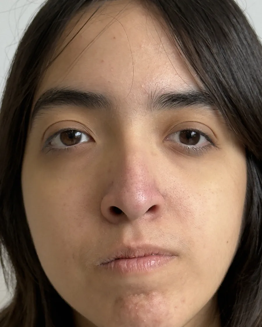 Antes de rinoplastia ultrasónica, vista frontal