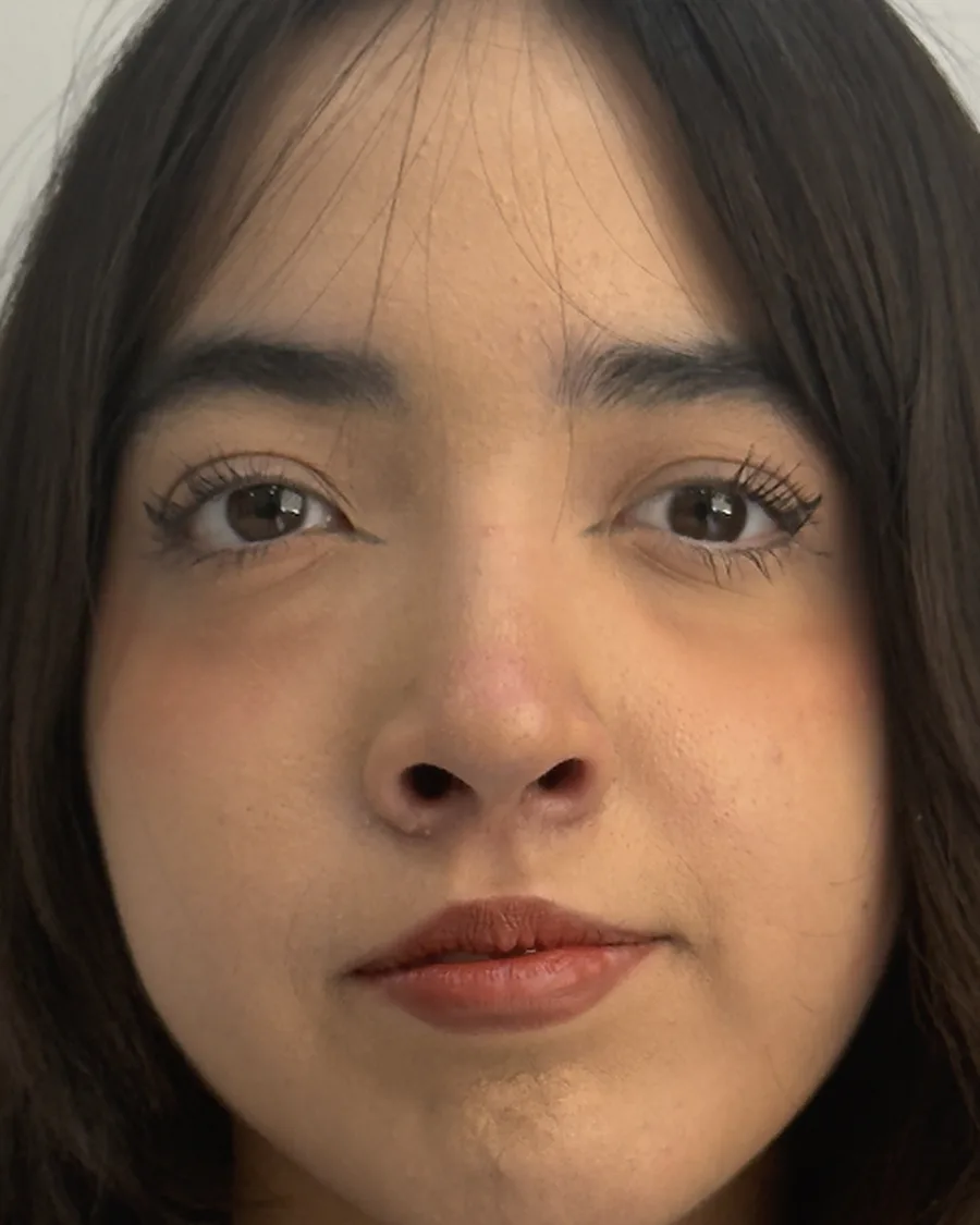 Después de rinoplastia ultrasónica a un mes, vista frontal