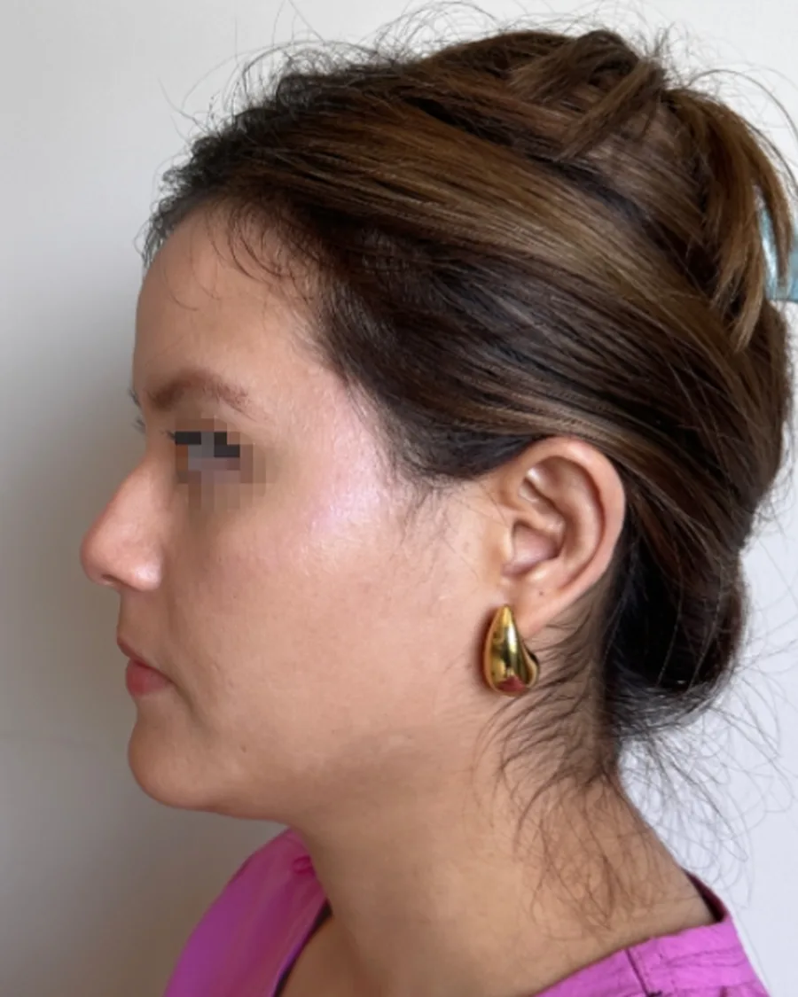 Antes de rinoplastia ultrasónica, vista de perfil