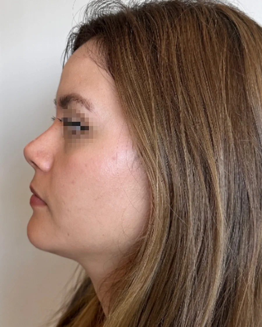 Después de rinoplastia ultrasónica, vista de perfil