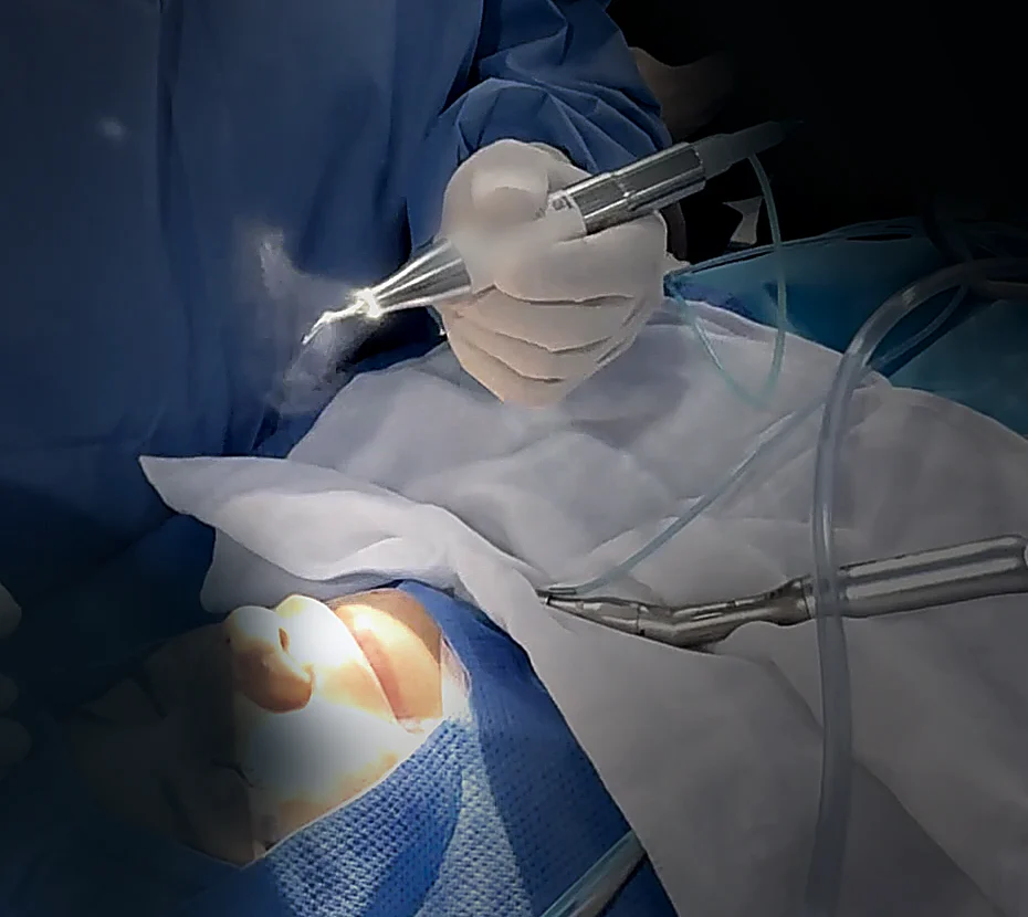 Instrumento de ultrasonido durante una rinoplastia en quirófano