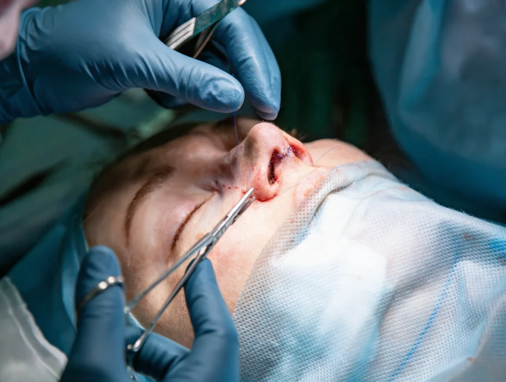 Cirujano suturando durante rinoplastia con guantes azules