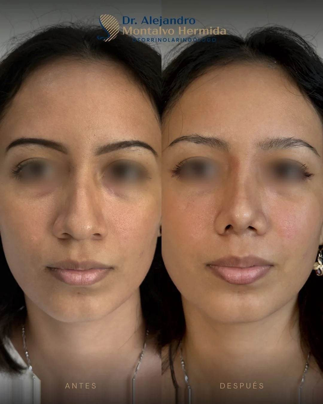 Rinoplastia 6 Caso 1: antes y después de rinoplastia ultrasónica, vista frontal