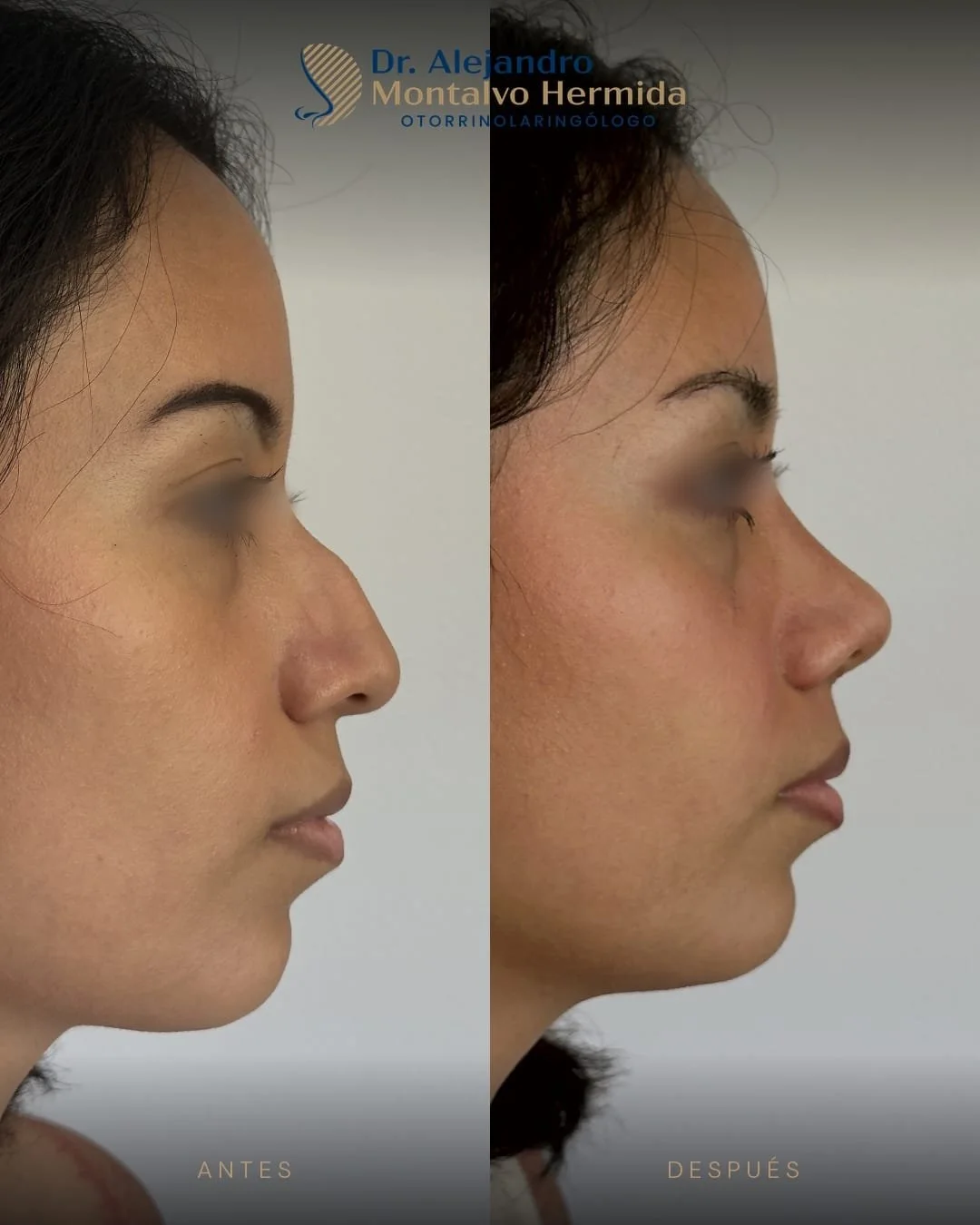 Inicio 4 Caso 1: antes y después de rinoplastia ultrasónica, vista de perfil