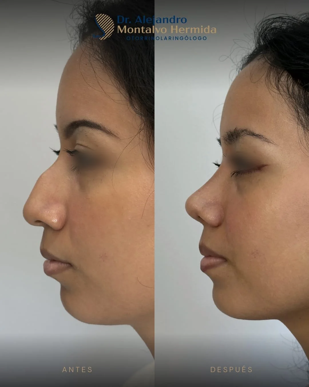Rinoplastia 5 Caso 1: antes y después de rinoplastia ultrasónica, vista perfil izquierdo