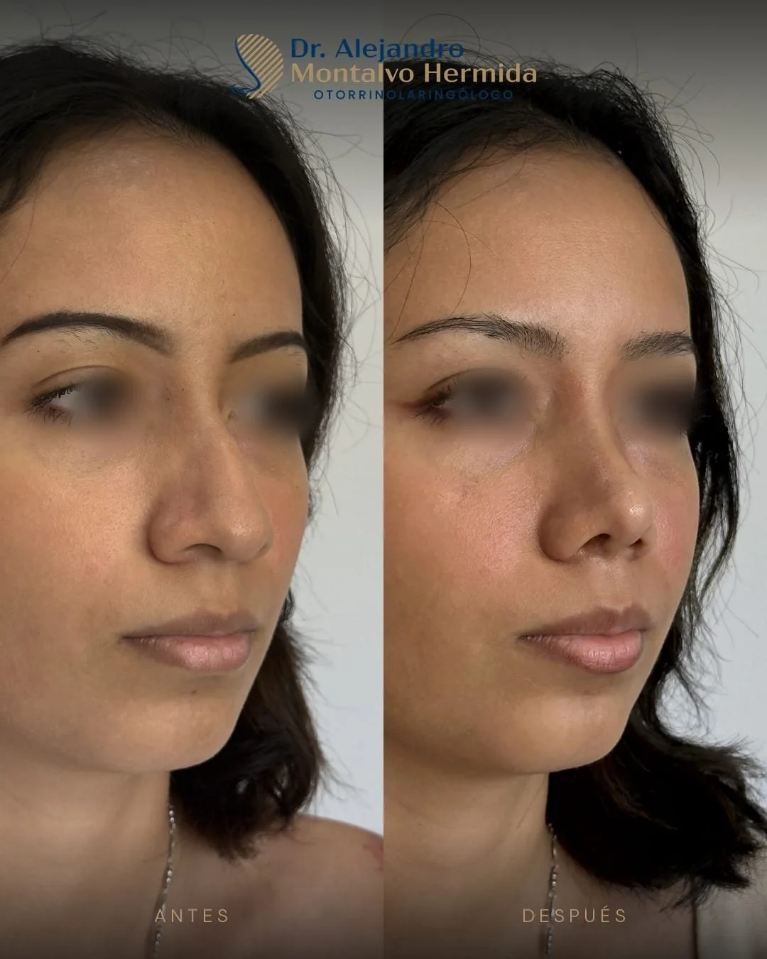 Rinoplastia 7 Caso 1: antes y después de rinoplastia ultrasónica, vista tres cuartos derecho
