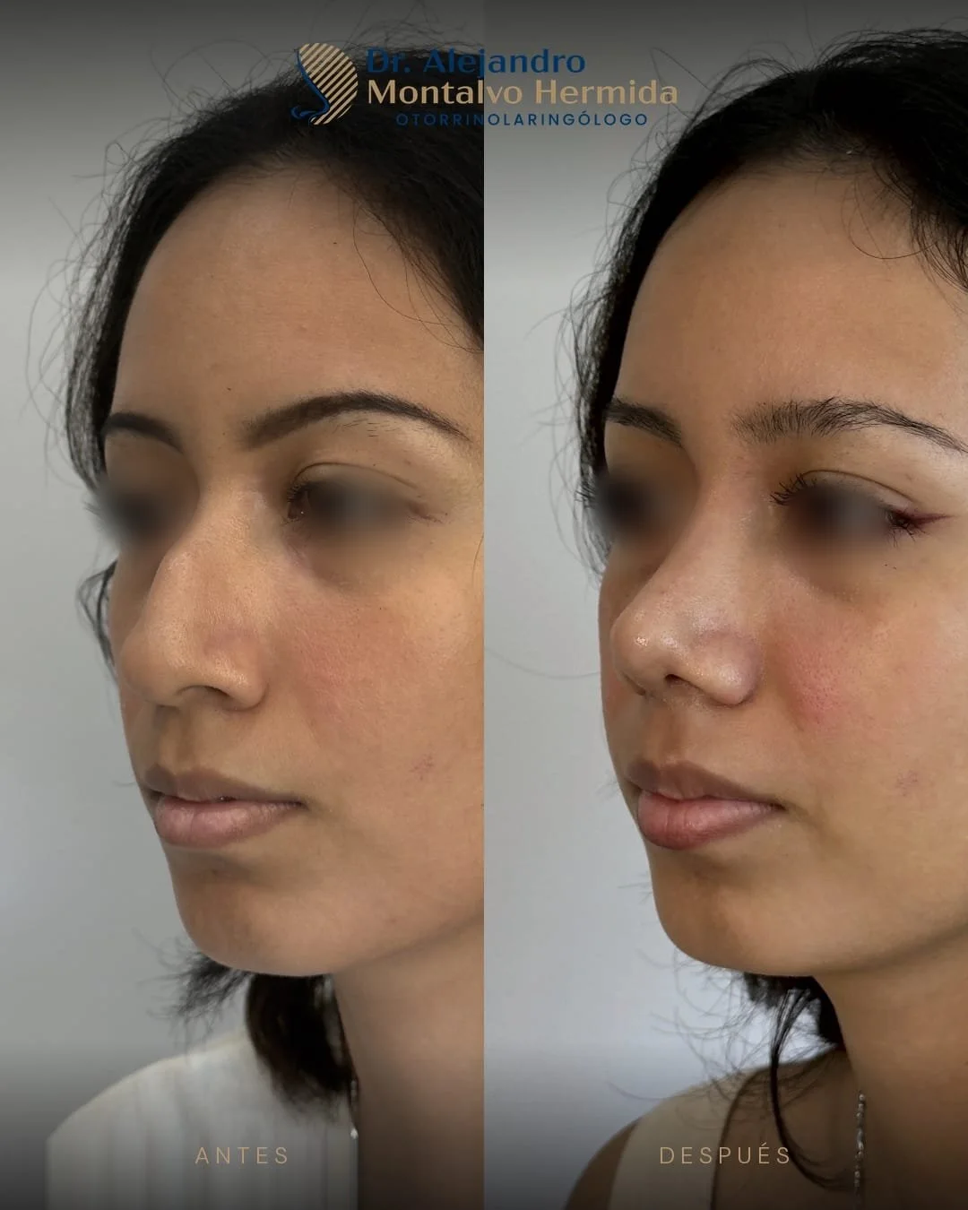 Rinoplastia 8 Caso 1: antes y después de rinoplastia ultrasónica, vista tres cuartos izquierdo