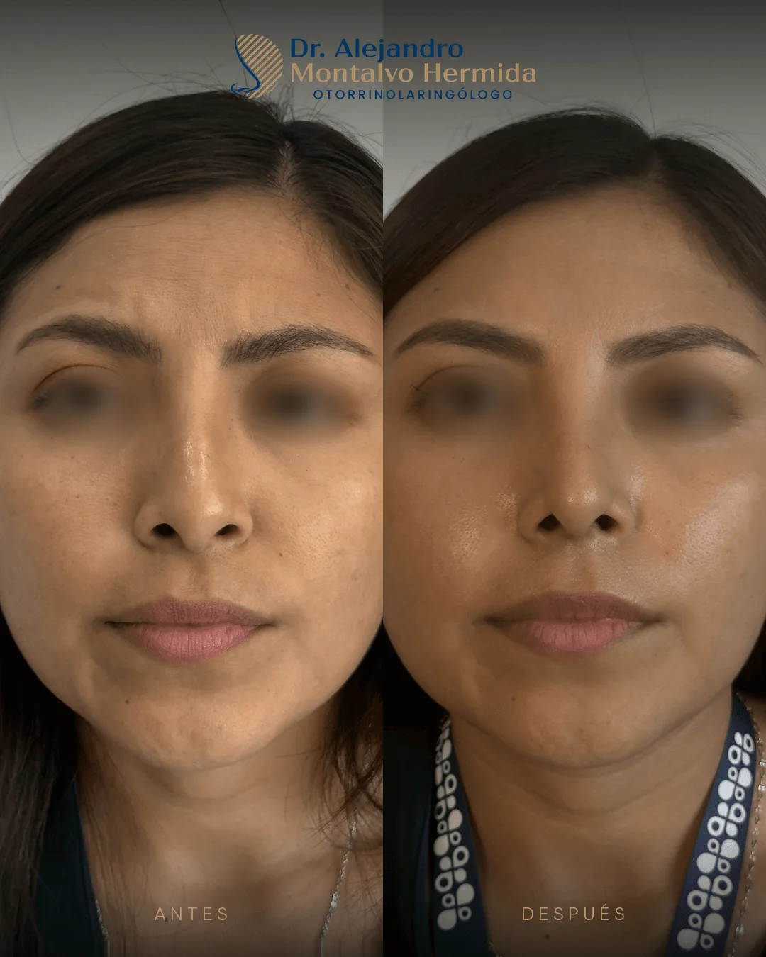 Rinoplastia 10 Caso 2: antes y después de rinoplastia ultrasónica, vista frontal