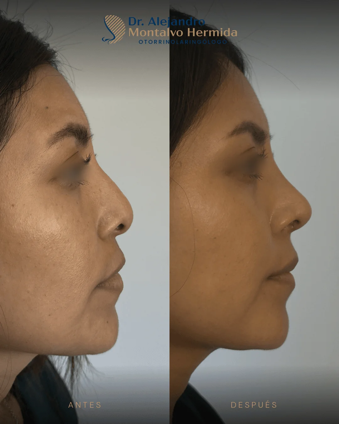 Rinoplastia 9 Caso 2: antes y después de rinoplastia ultrasónica, vista perfil izquierdo