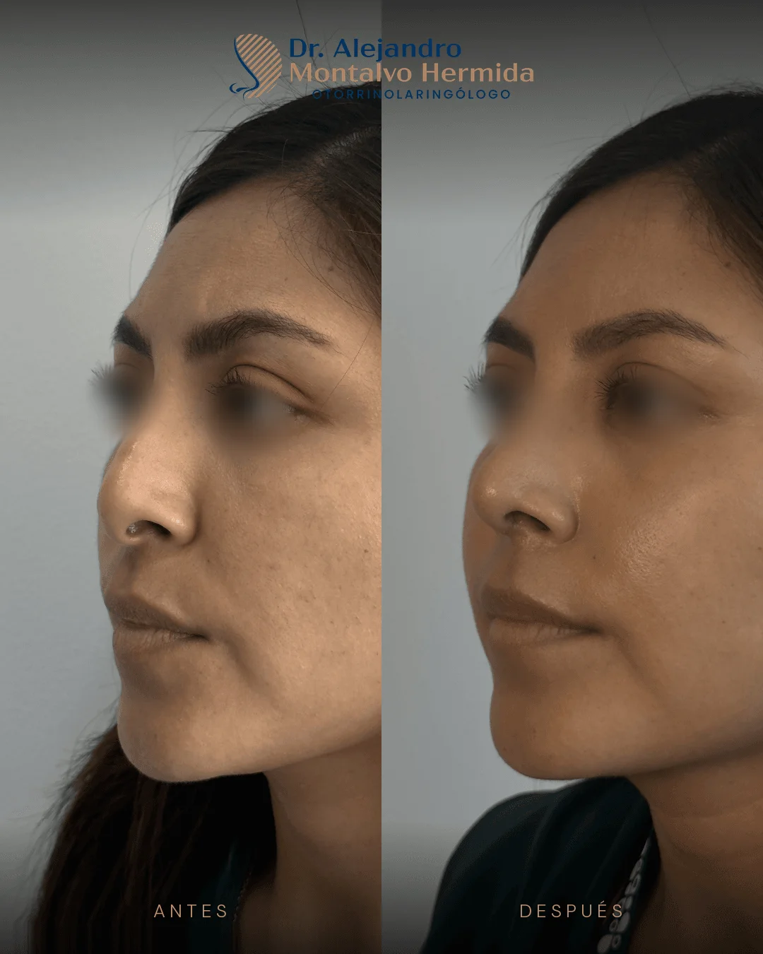 Rinoplastia 11 Caso 2: antes y después de rinoplastia ultrasónica, vista tres cuartos izquierdo