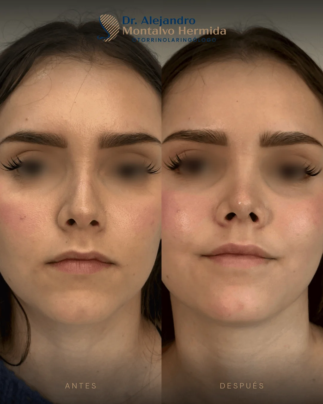 Inicio 5 Caso 3: antes y después de rinoplastia ultrasónica, vista frontal