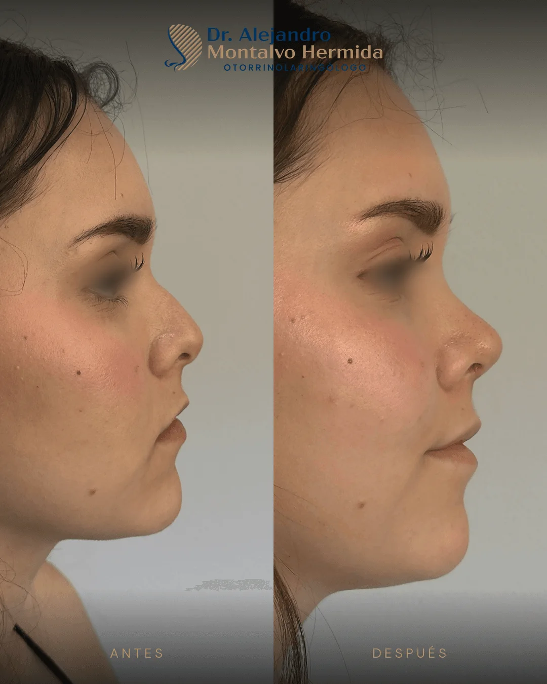 Rinoplastia 12 Caso 3: antes y después de rinoplastia ultrasónica, vista perfil derecho