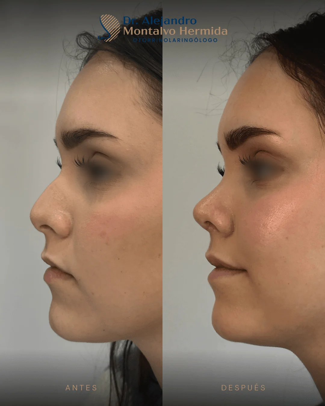 Rinoplastia 13 Caso 3: antes y después de rinoplastia ultrasónica, vista perfil izquierdo