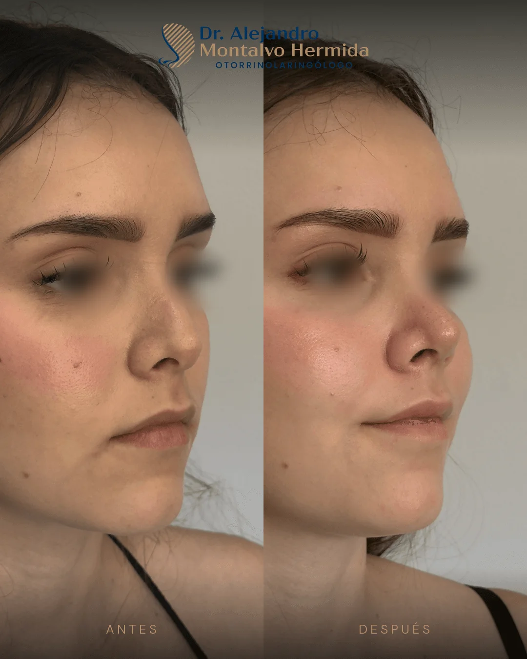 Rinoplastia 15 Caso 3: antes y después de rinoplastia ultrasónica, vista tres cuartos derecho