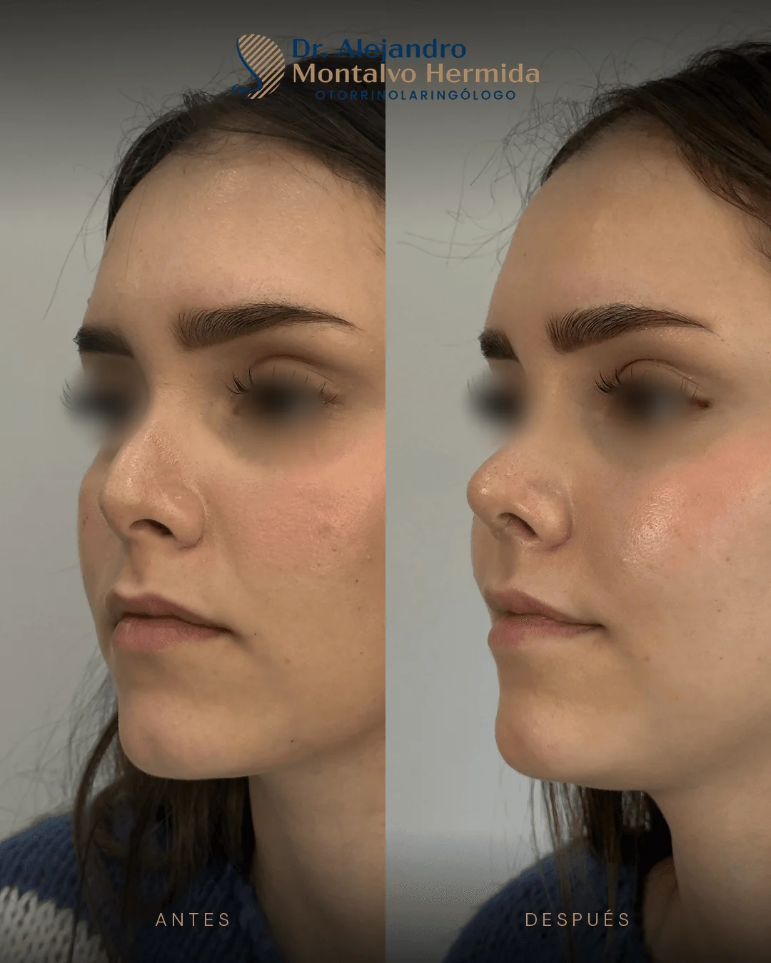 Rinoplastia 16 Caso 3: antes y después de rinoplastia ultrasónica, vista tres cuartos izquierdo