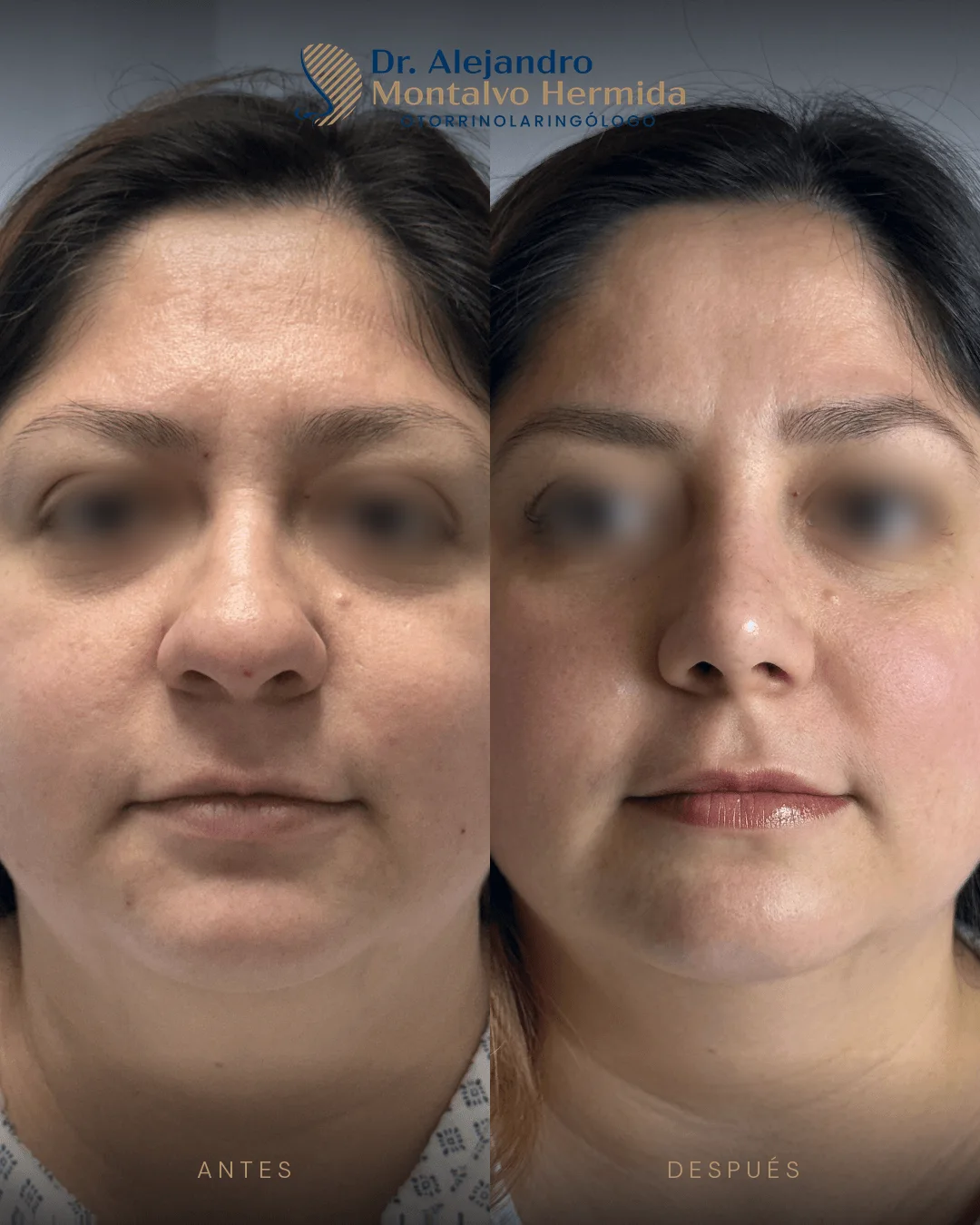 Rinoplastia 18 Caso 8: antes y después de rinoplastia ultrasónica, vista frontal