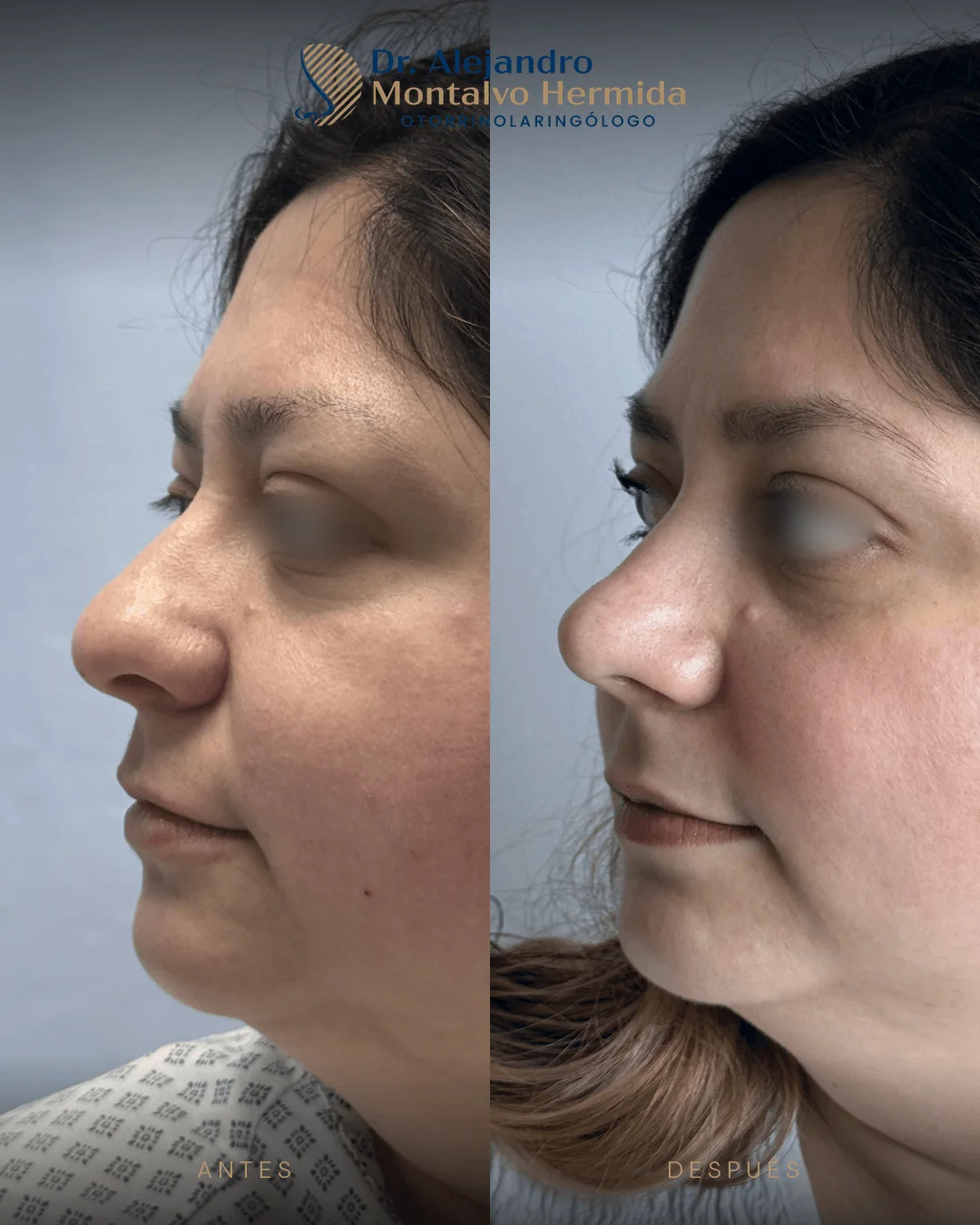 Rinoplastia 17 Caso 8: antes y después de rinoplastia ultrasónica, vista perfil izquierdo