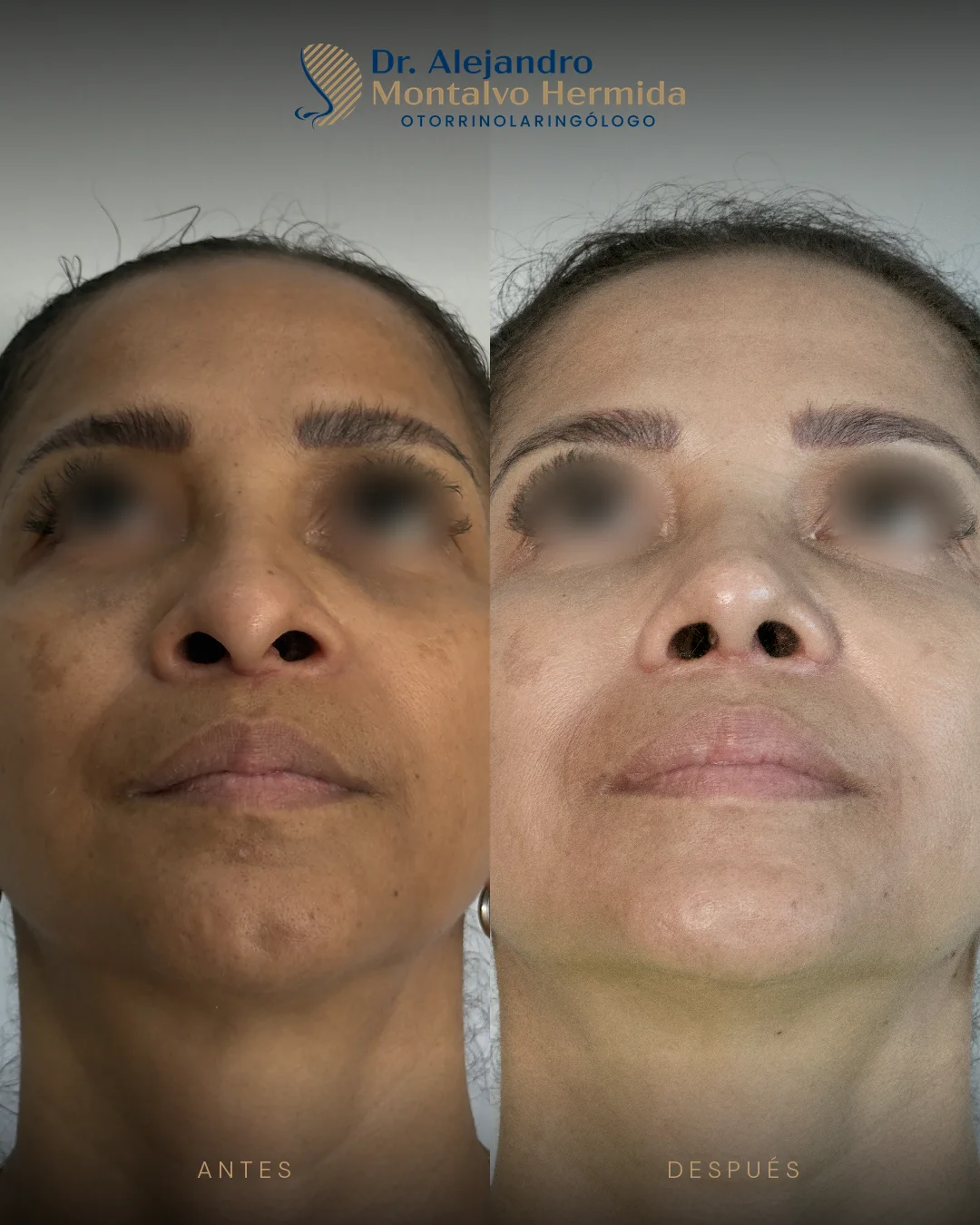 Rinoplastia 24 Caso 9: antes y después de rinoplastia ultrasónica, vista basal