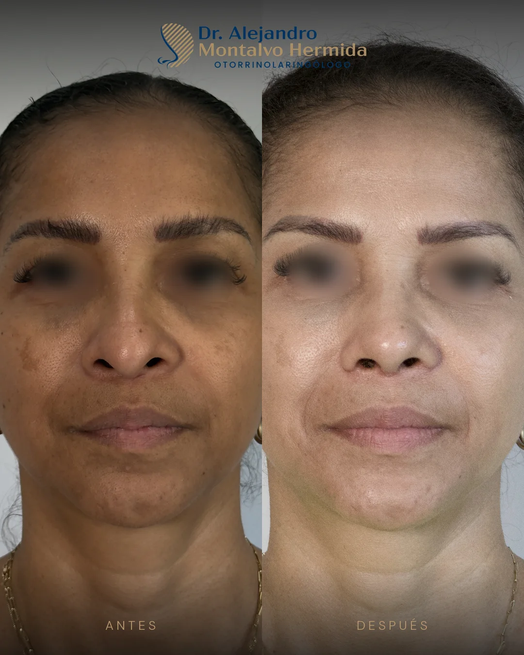 Rinoplastia 21 Caso 9: antes y después de rinoplastia ultrasónica, vista frontal
