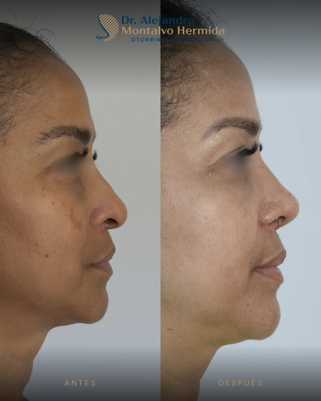 Rinoplastia 19 Caso 9: antes y después de rinoplastia ultrasónica, vista perfil derecho