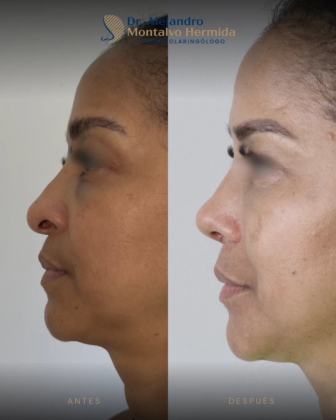 Rinoplastia 20 Caso 9: antes y después de rinoplastia ultrasónica, vista perfil izquierdo