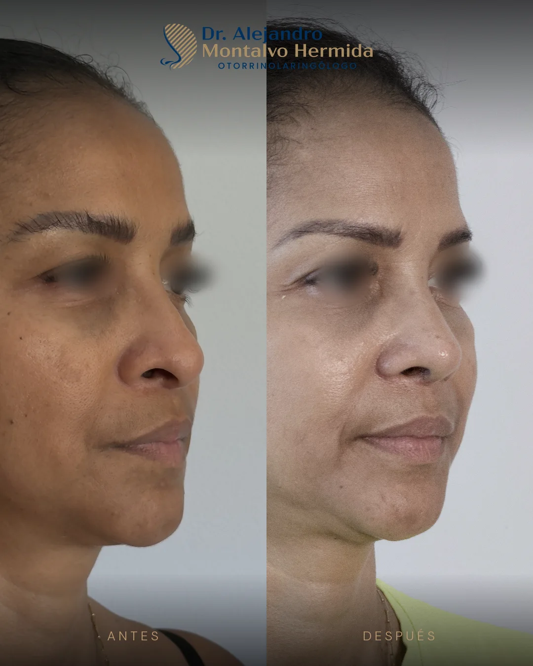Rinoplastia 22 Caso 9: antes y después de rinoplastia ultrasónica, vista tres cuartos derecho