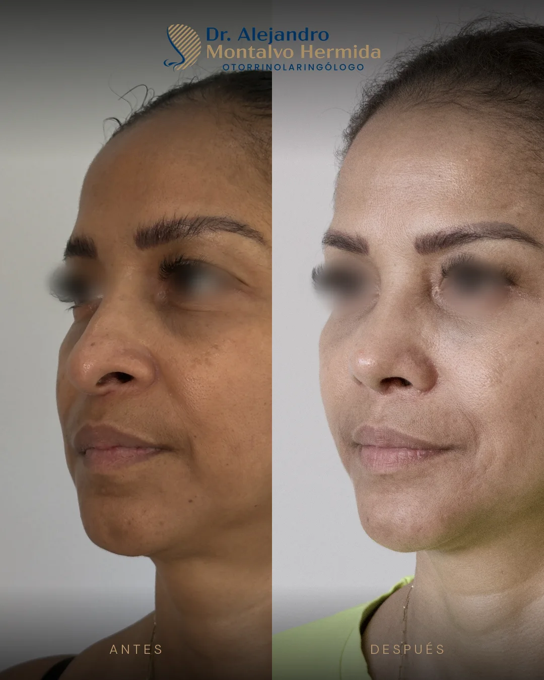 Inicio 6 Caso 9: antes y después de rinoplastia ultrasónica, vista tres cuartos